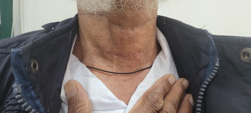Treatment of Thyroid Swellings in raipur Treatment of Thyroid Swellings in raipur
