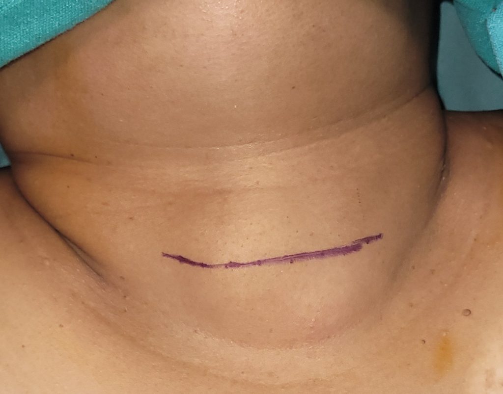 Treatment of Thyroid Swellings in raipur Treatment of Thyroid Swellings in raipur