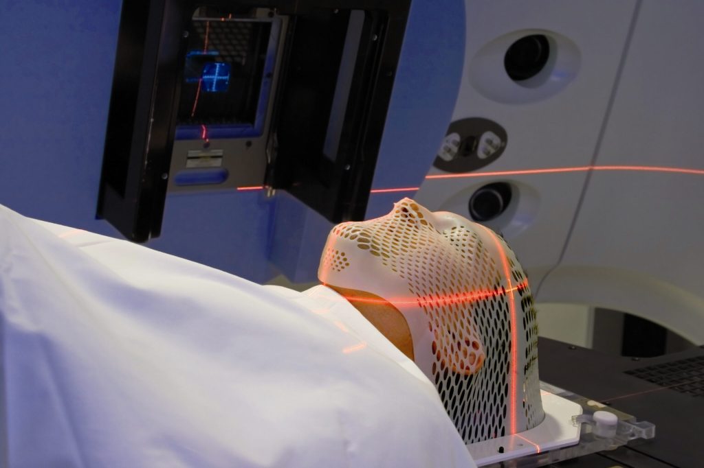 Radiation therapy after Surgery Radiation therapy after Surgery
