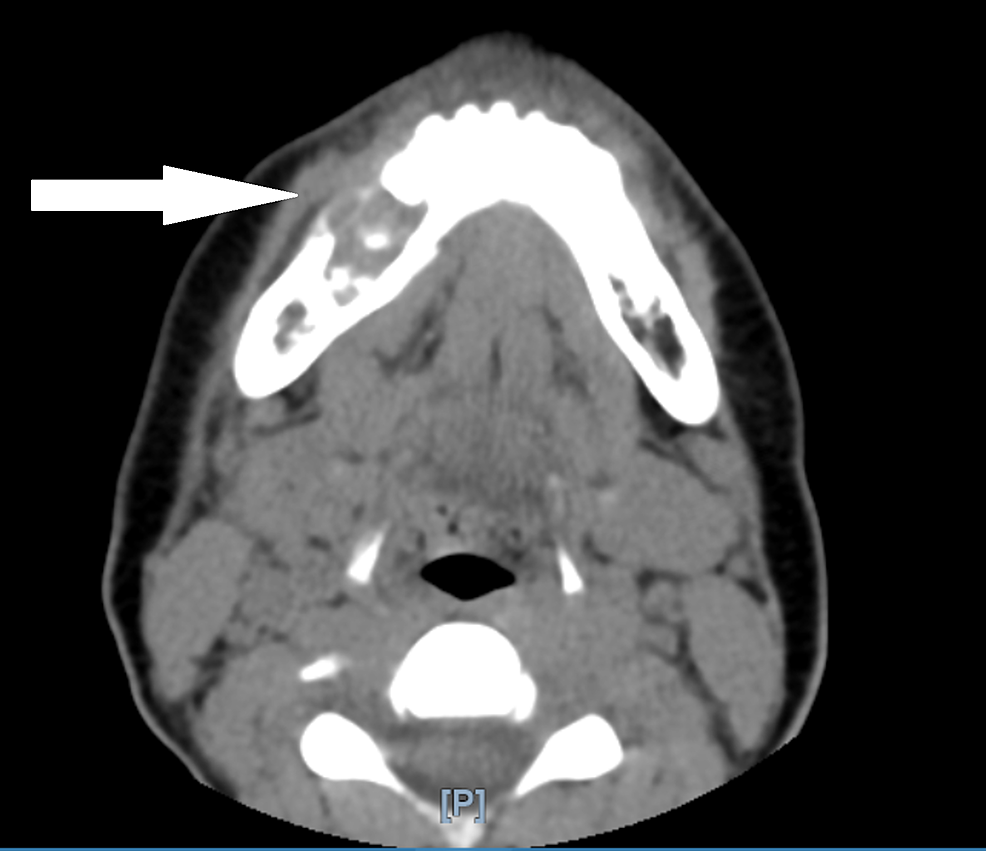 Image 11 CT image 1.50secs Diagnosis of Mouth Cancer