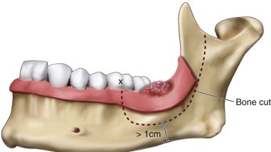 Print Treatment of Oral Cancer