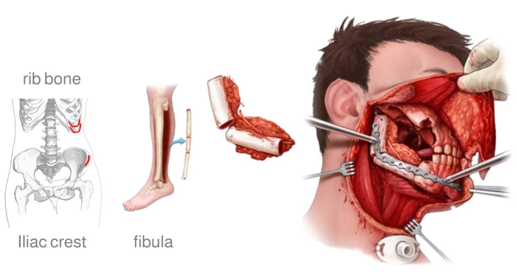 Treatment of Oral Cancer Treatment of Oral Cancer