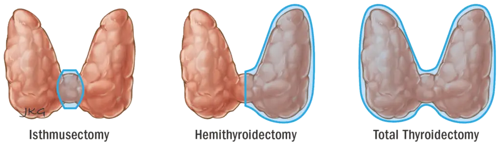 Treatment of Thyroid Swellings in raipur Treatment of Thyroid Swellings in raipur