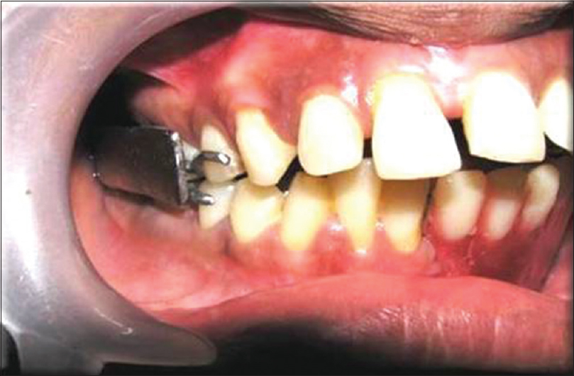 Rehabilitation after Oral Cancer Surgery Rehabilitation after Oral Cancer Surgery